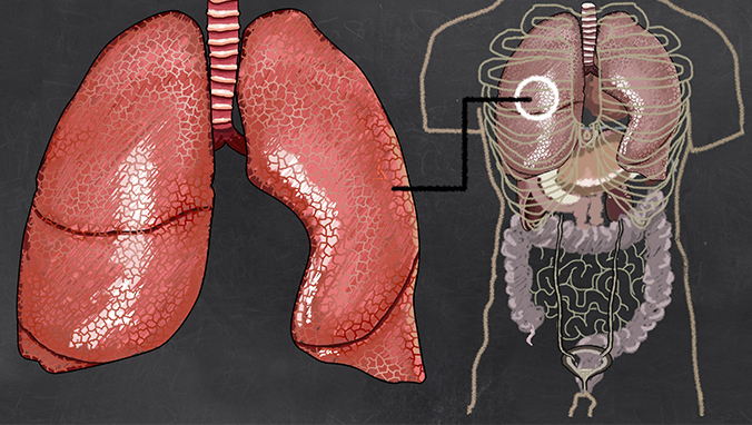 What is lobular cell lung cancer