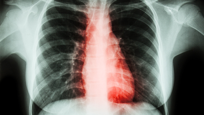 What are the symptoms of lung cancer pain
