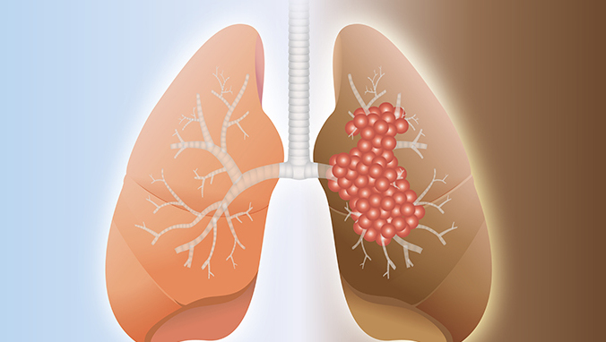 Can lung cancer be cured by taking medicine?