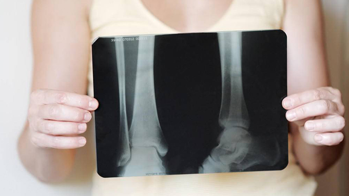 Cheats for preventing osteoporosis